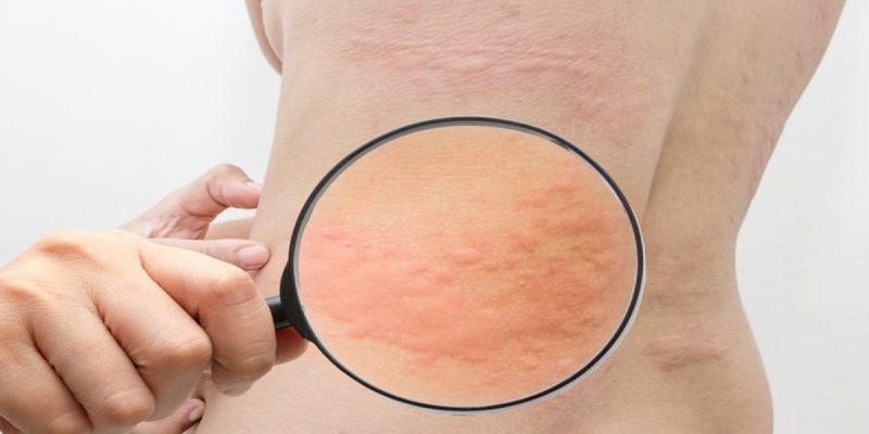 Histamin İntoleransı